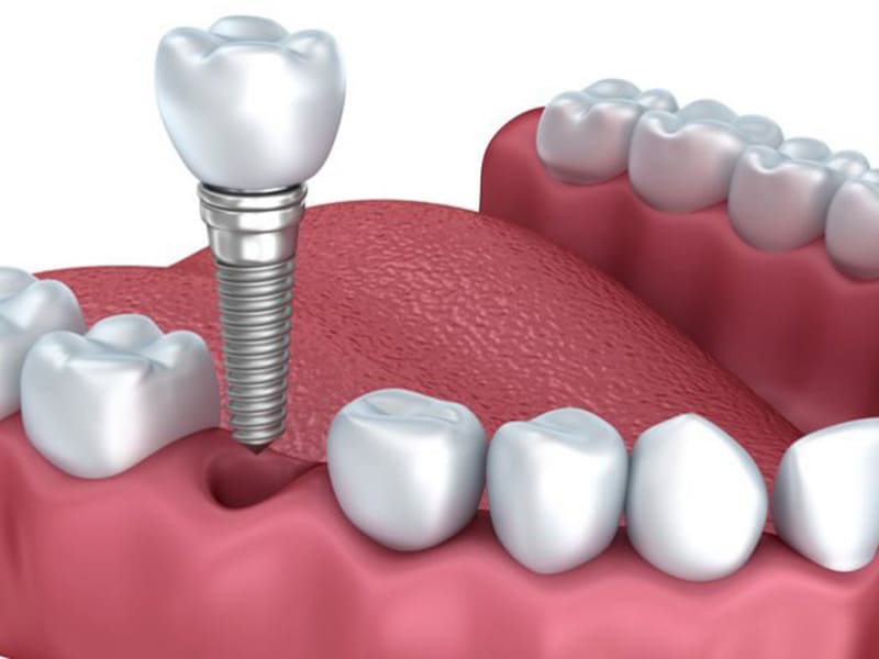 Trattamenti Dada Odontoiatrica centro dentistico Prato - Chirurgia orale e Impianti 1